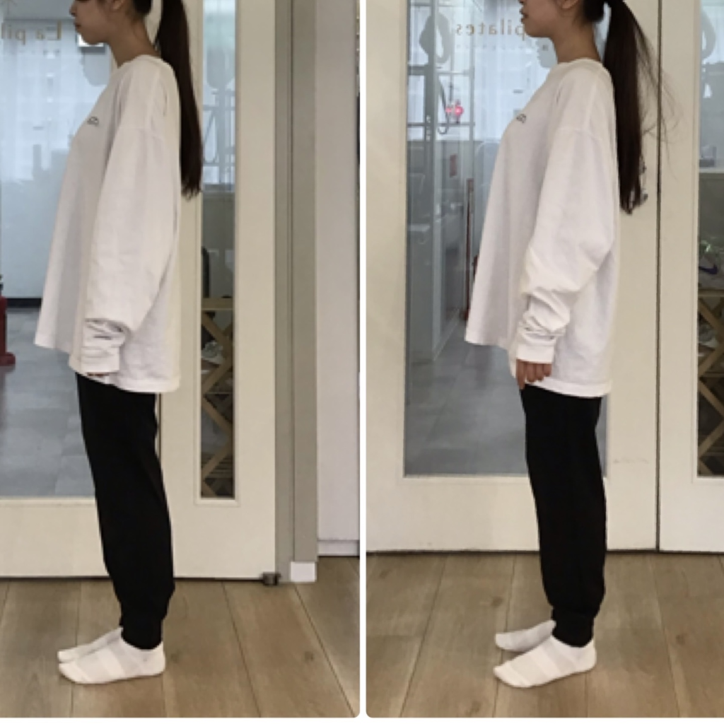体験レッスン一回での姿勢の変化（ストレートネック改善）