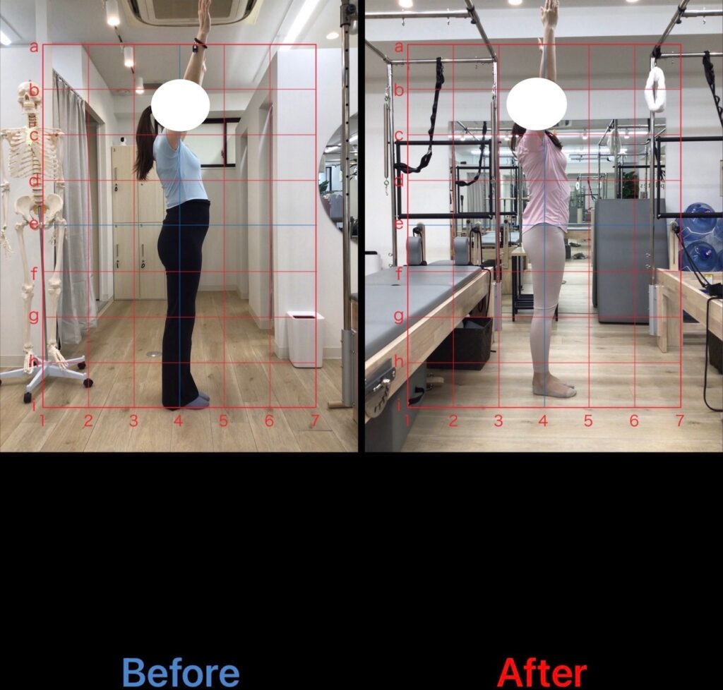 4ヶ月間週1回マシンピラティスと整体を受けた女性の変化